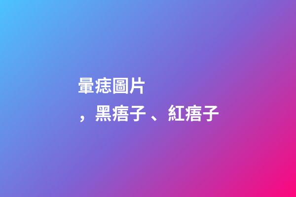 暈痣圖片，黑痦子、紅痦子
